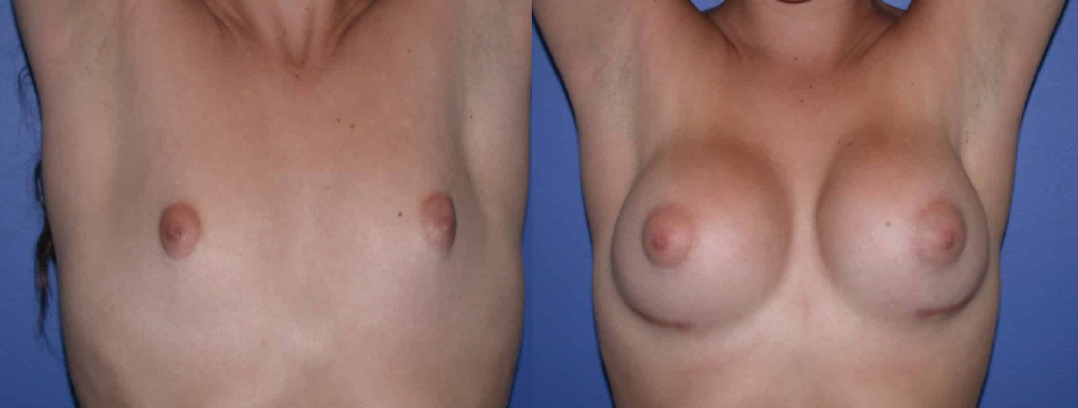 Before and After Image: Breast Augmentation with Silicone - front
