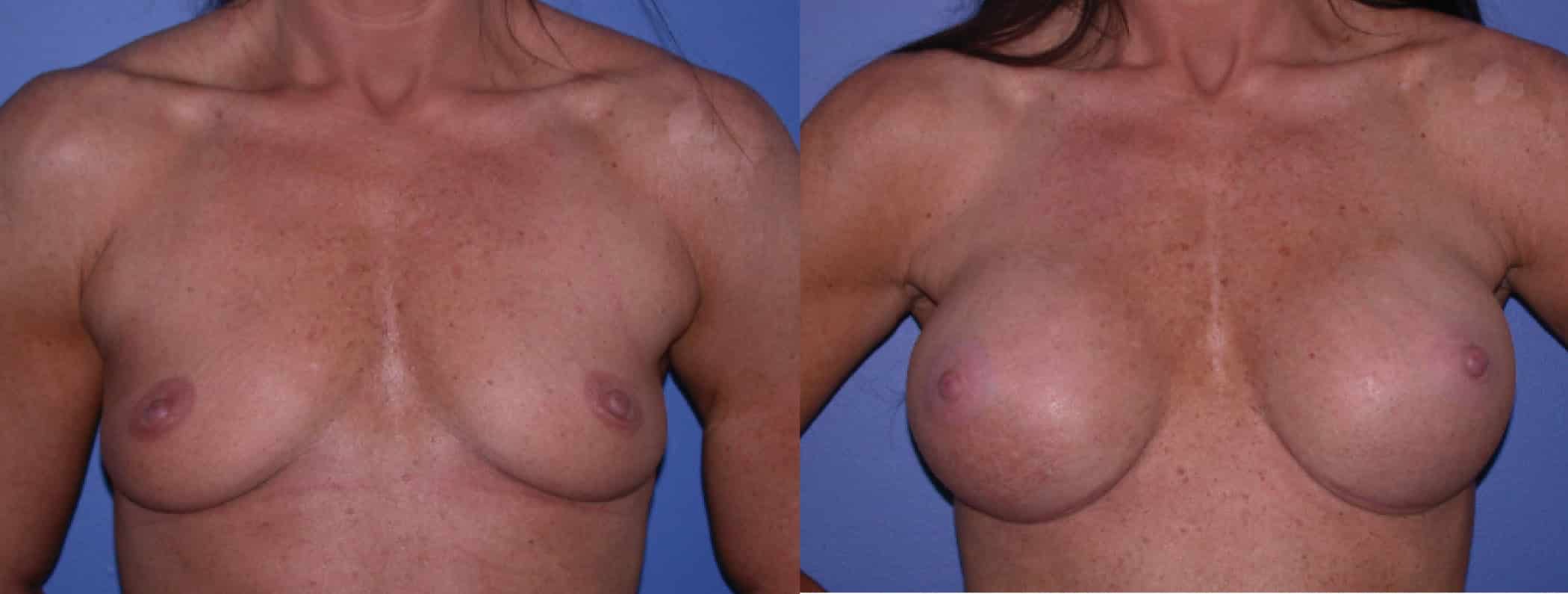 Before and After Image: Breast Augmentation with Silicone - front