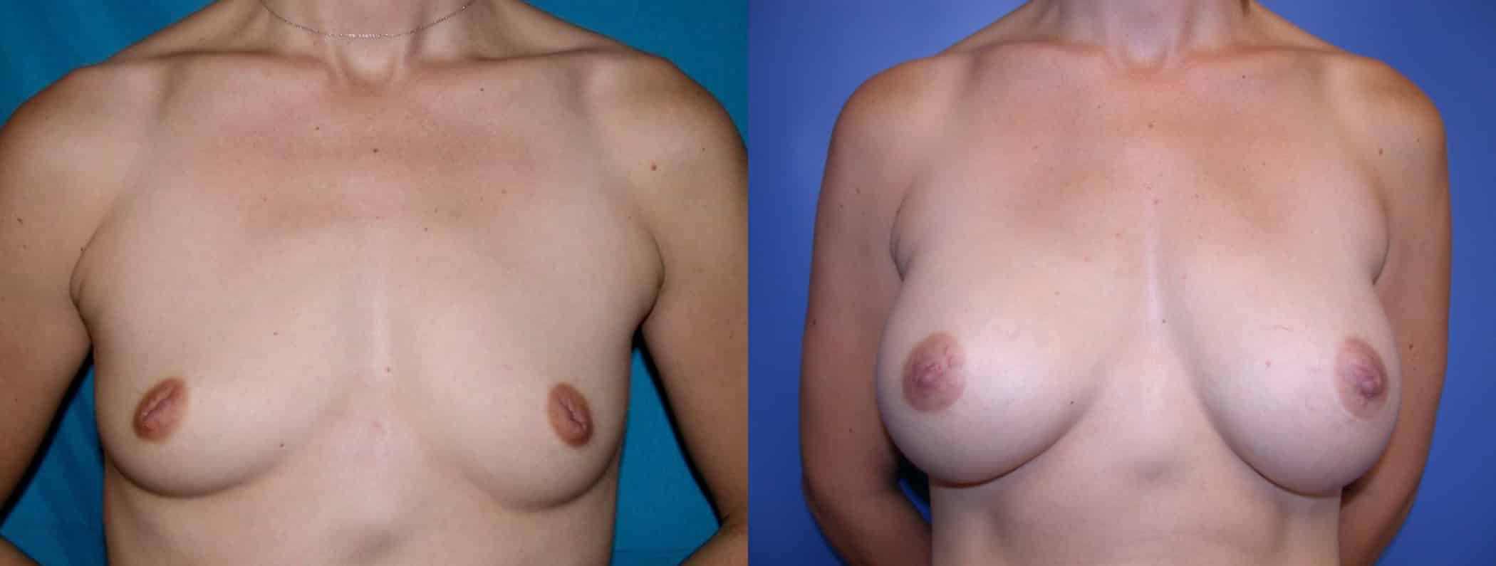 Before and After Image: Breast Augmentation with Silicone - front