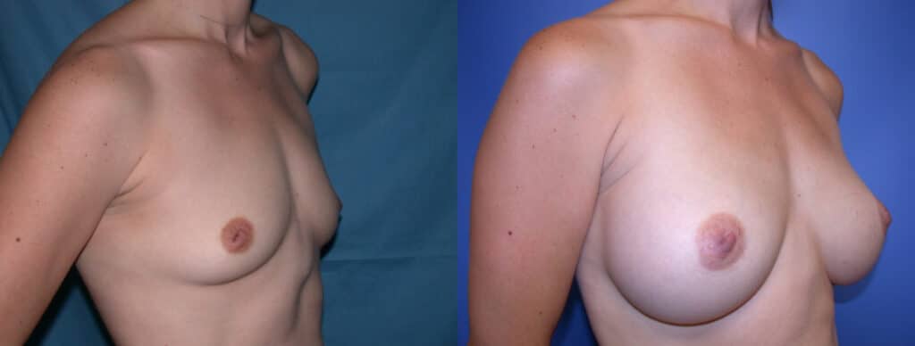 Before and After Image: Breast Augmentation with Silicone - right-front-oblique