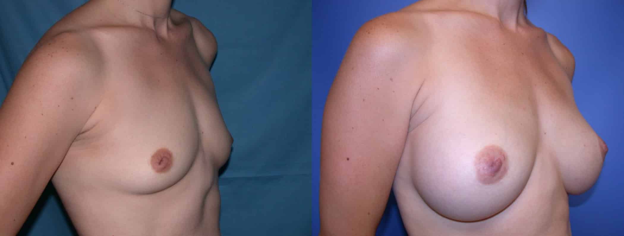 Before and After Image: Breast Augmentation with Silicone - right-front-oblique
