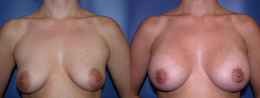 Before and After Image: Breast Augmentation with Lift - front