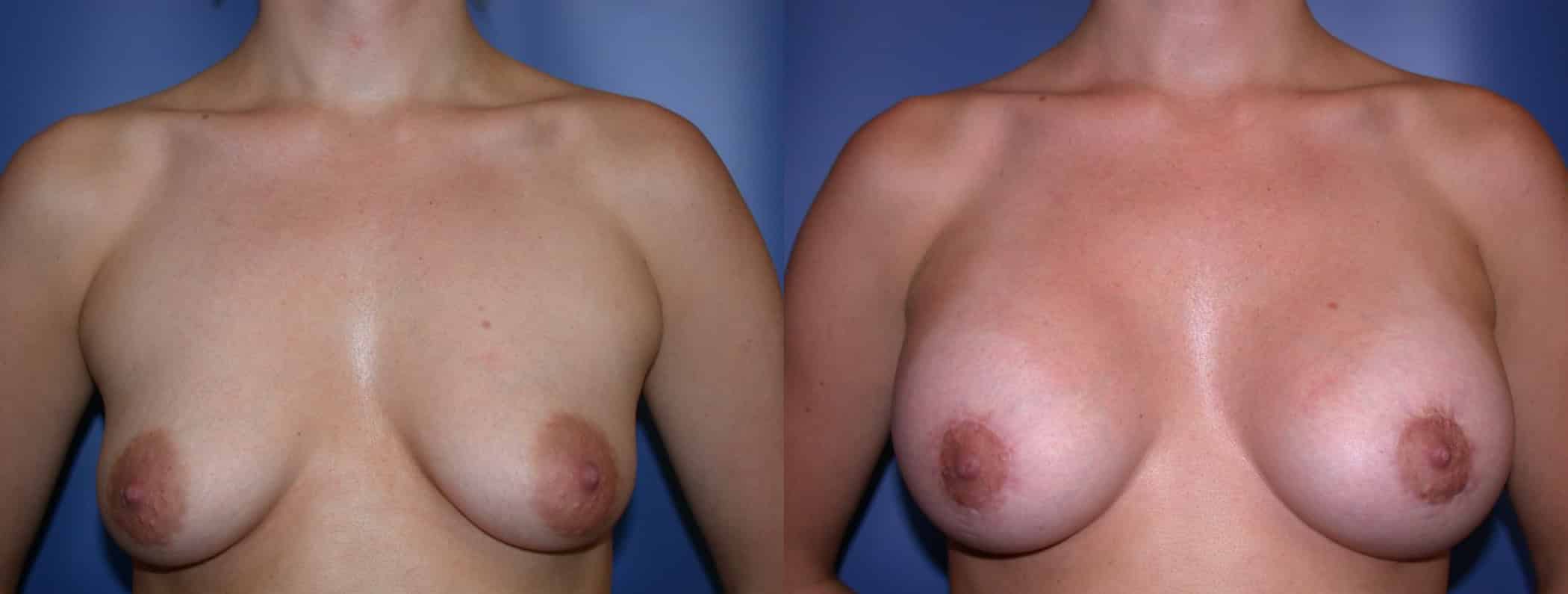 Before and After Image: Breast Augmentation with Lift - front
