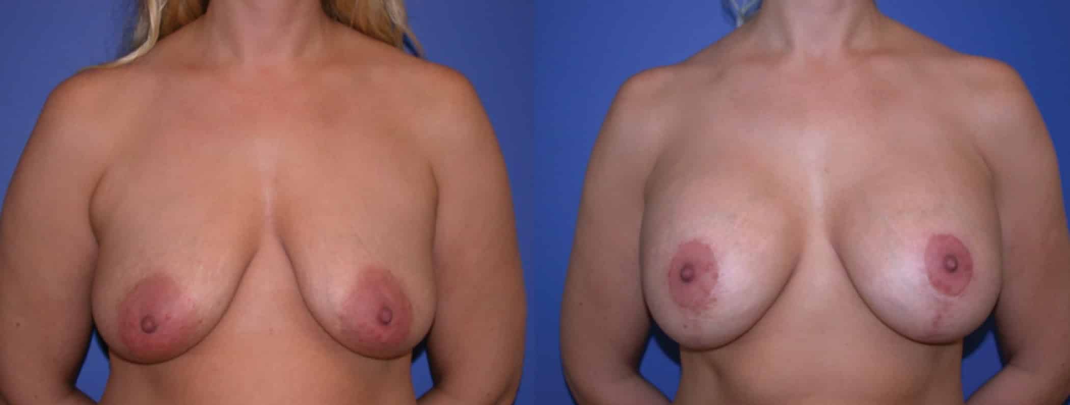 Before and After Image: Breast Revision - front