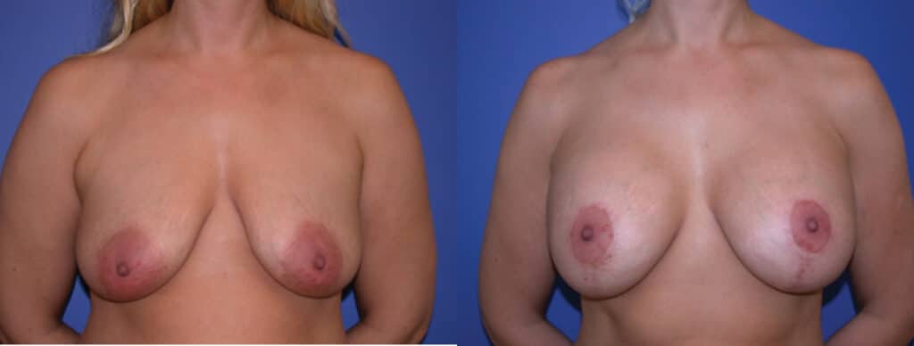 Before and After Image: Augmentation With Lift - front