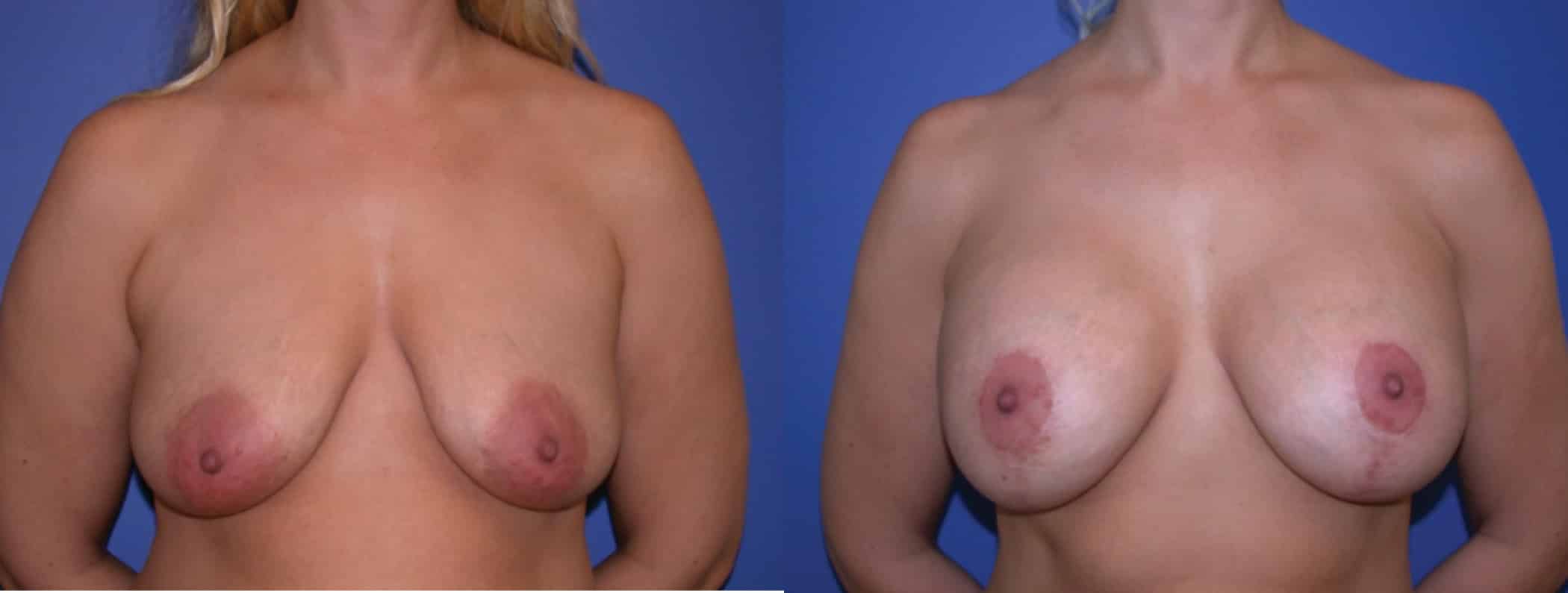 Before and After Image: Augmentation With Lift - front