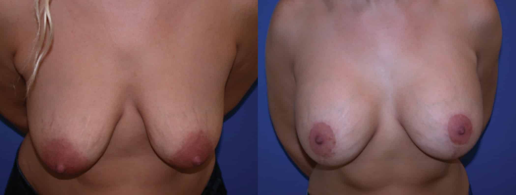 Before and After Image: Augmentation With Lift - front