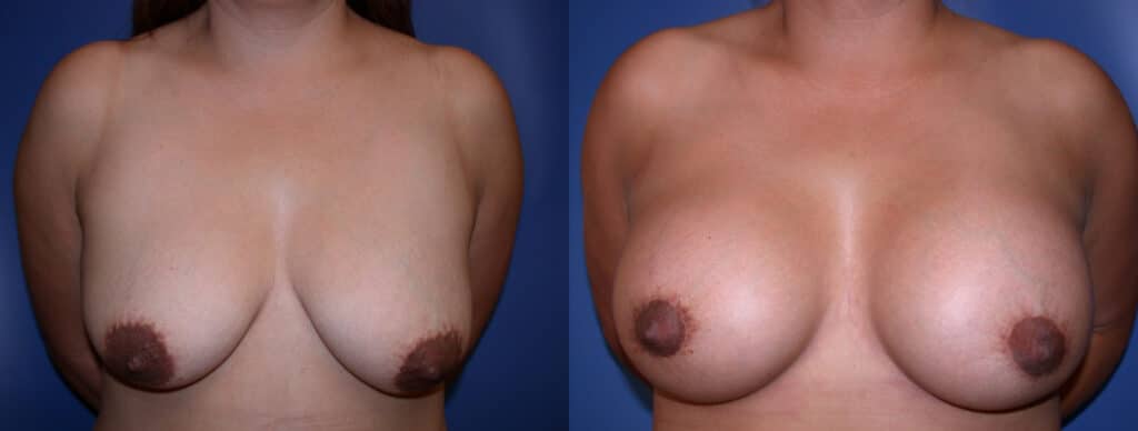 Before and After Image: Augmentation With Lift - front