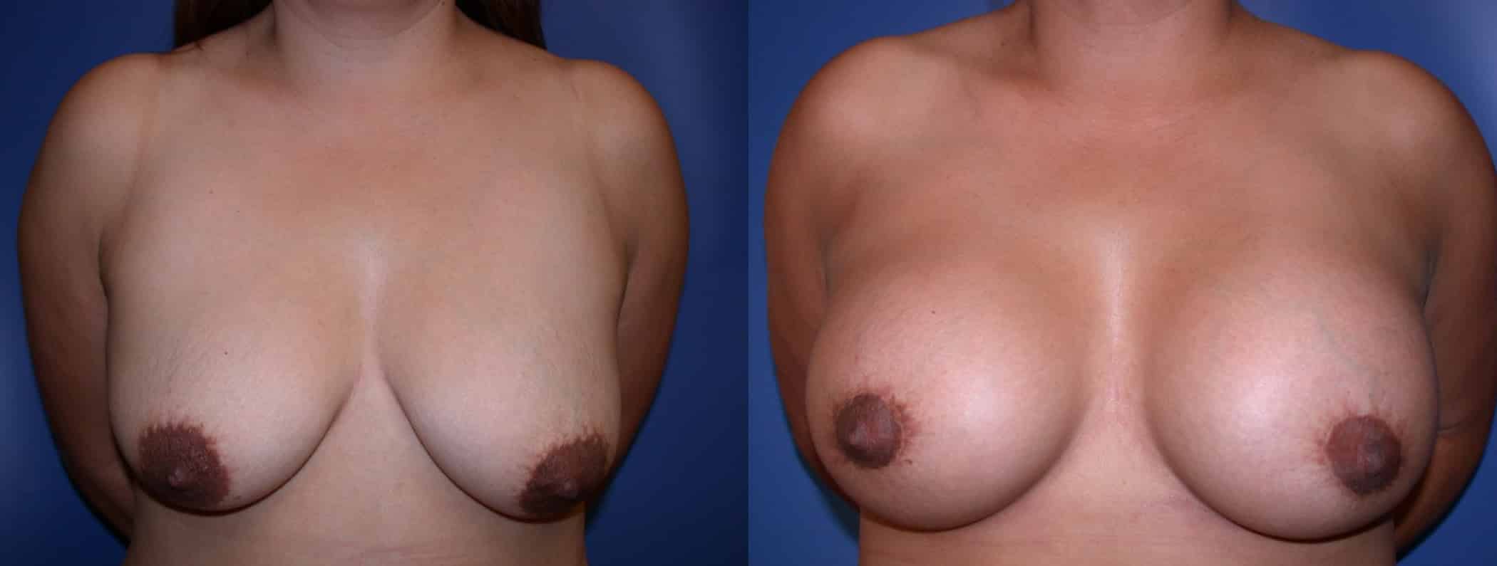 Before and After Image: Augmentation With Lift - front