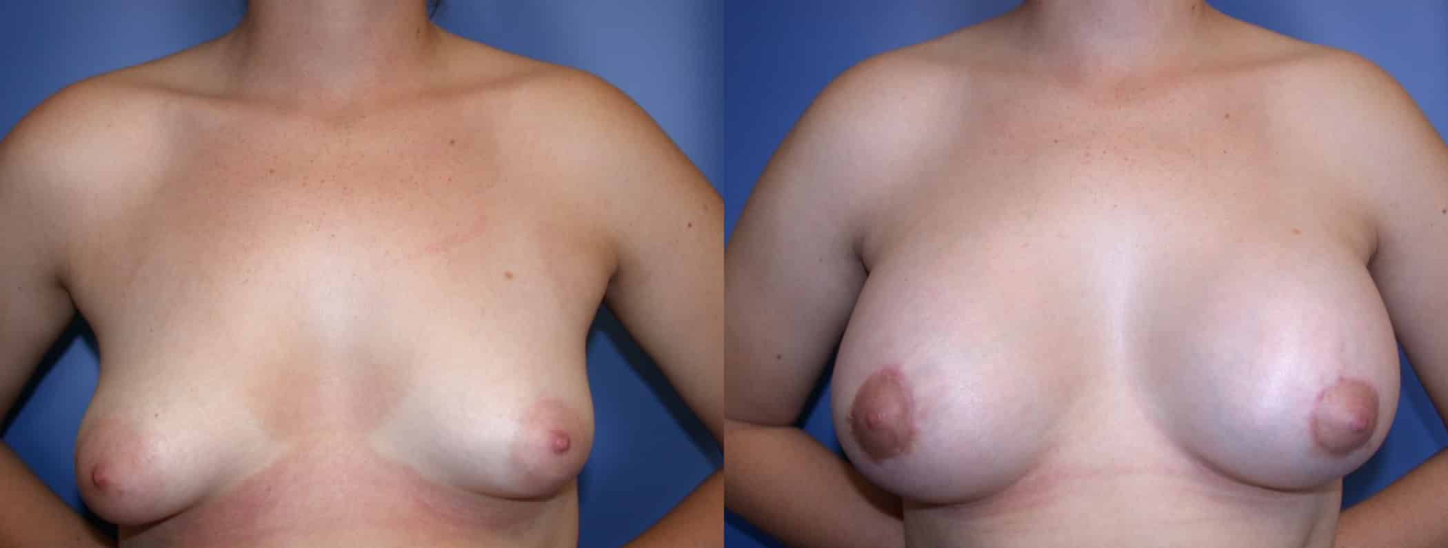 Before and After Image: Augmentation With Lift - front