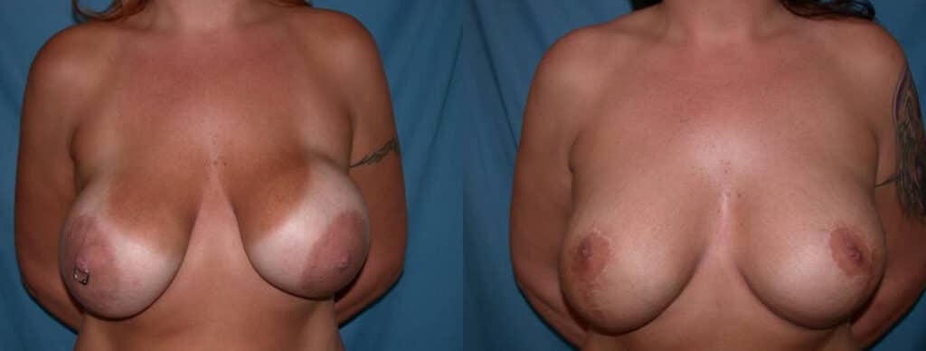 Before and After Image: Breast Augmentation with Lift - front