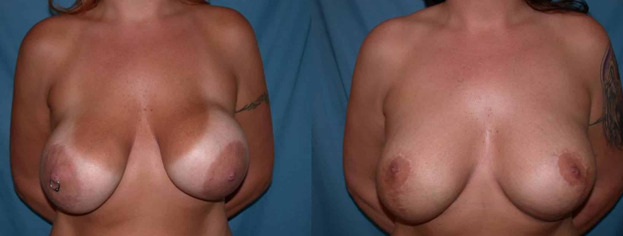 Before and After Image: Breast Augmentation with Lift - front