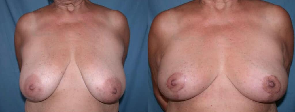Before and After Image: Augmentation With Lift - front