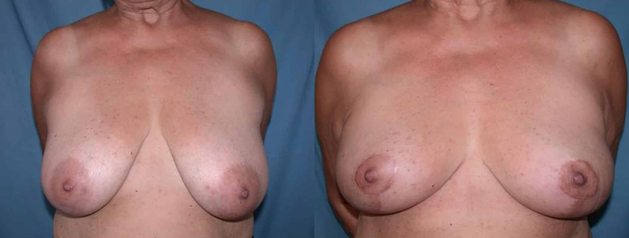 Before and After Image: Augmentation With Lift - front