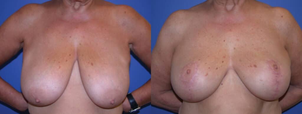 Before and After Image: Breast Lift - front