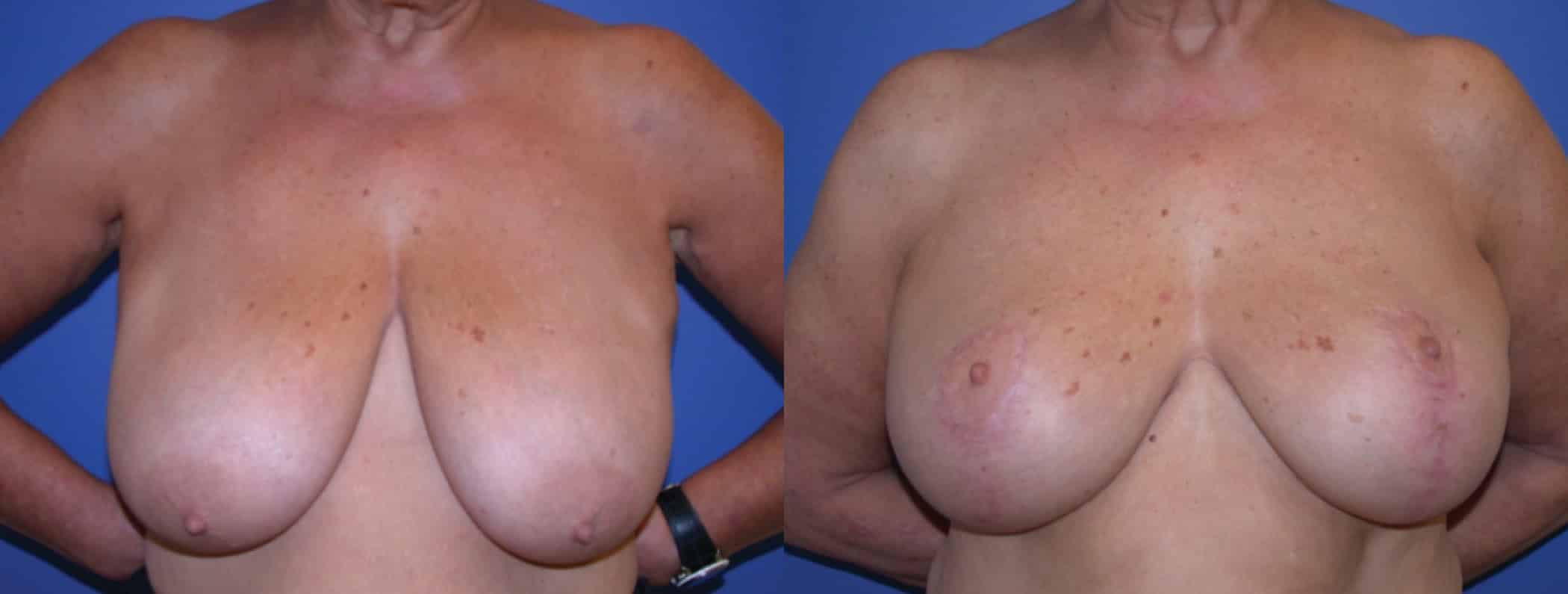 Before and After Image: Breast Lift - front