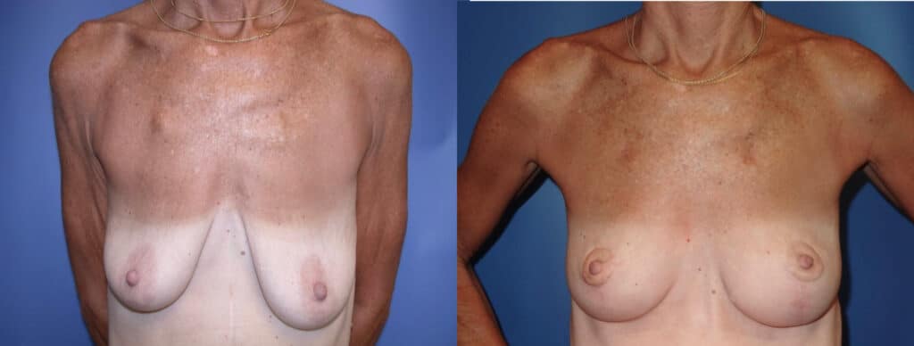 Before and After Image: Breast Lift - front