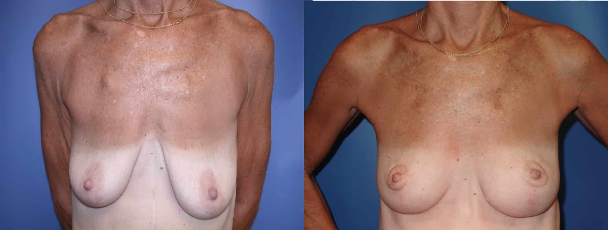 Before and After Image: Breast Lift - front