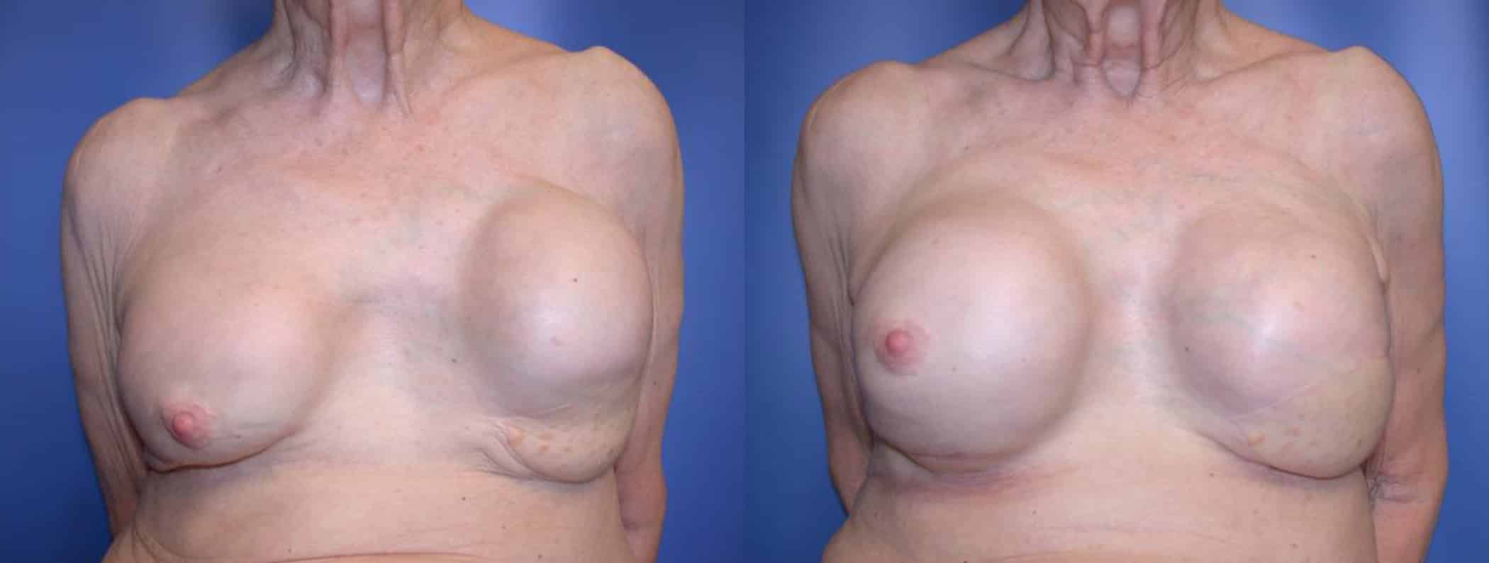 Before and After Image: Breast Reconstruction - front