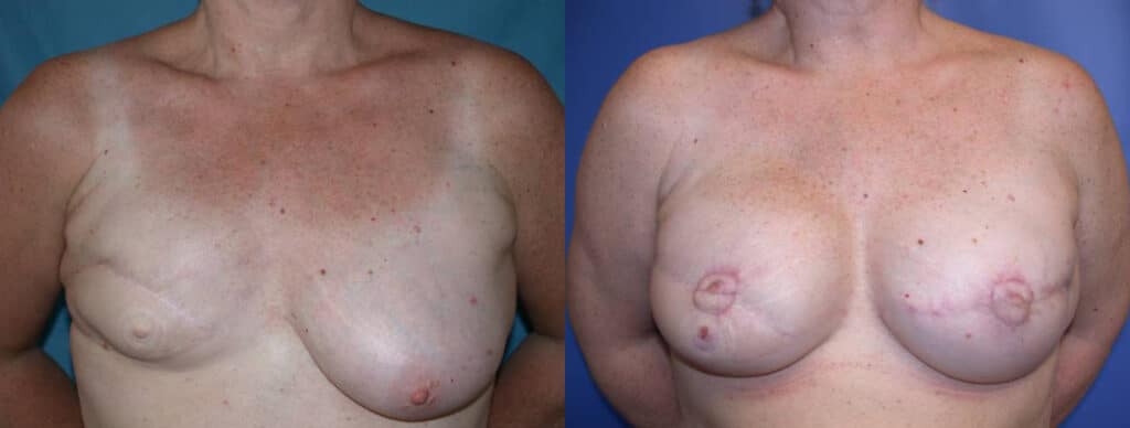 Before and After Image: Breast Reconstruction - front