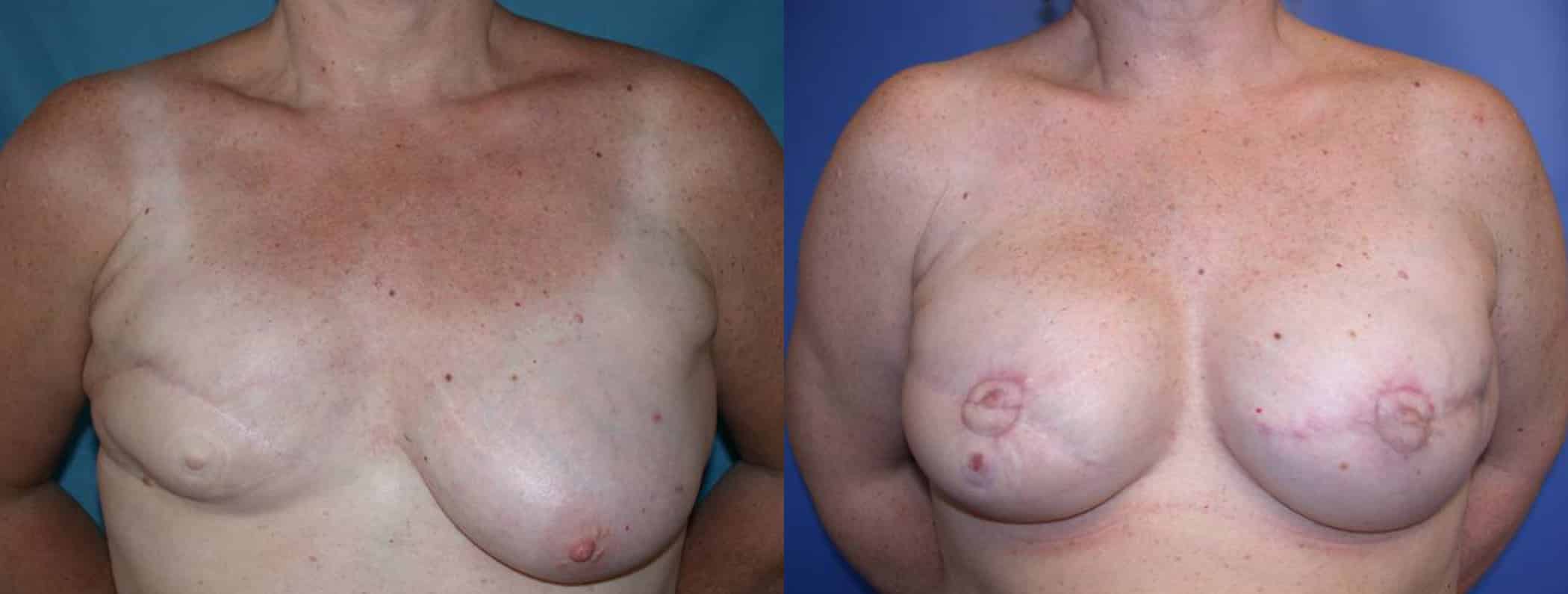 Before and After Image: Breast Reconstruction - front