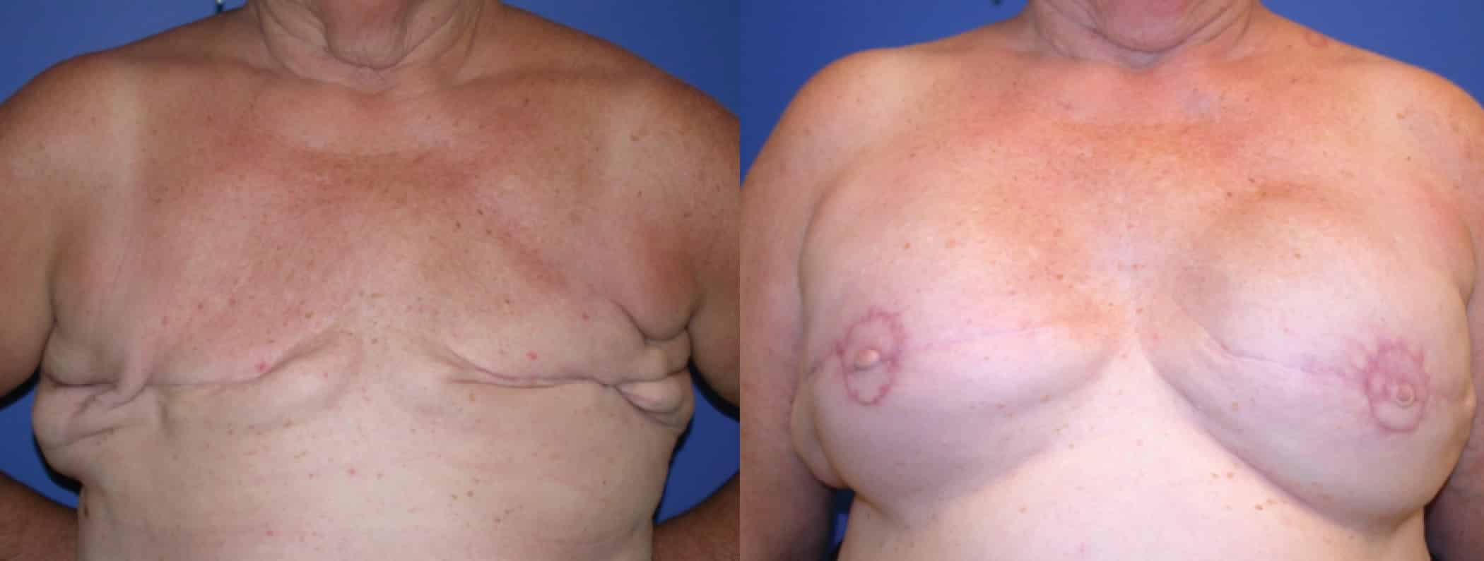Before and After Image: Breast Reconstruction - front