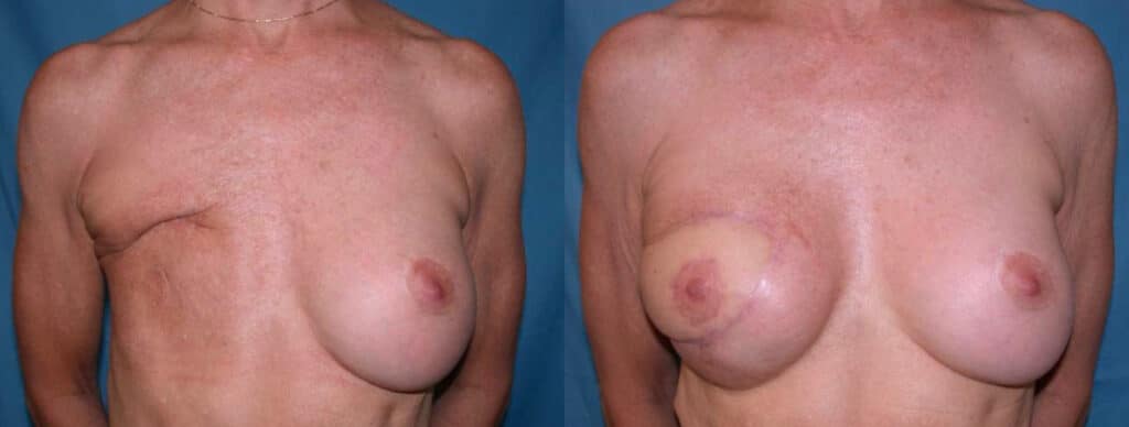 Before and After Image: Breast Reconstruction - front