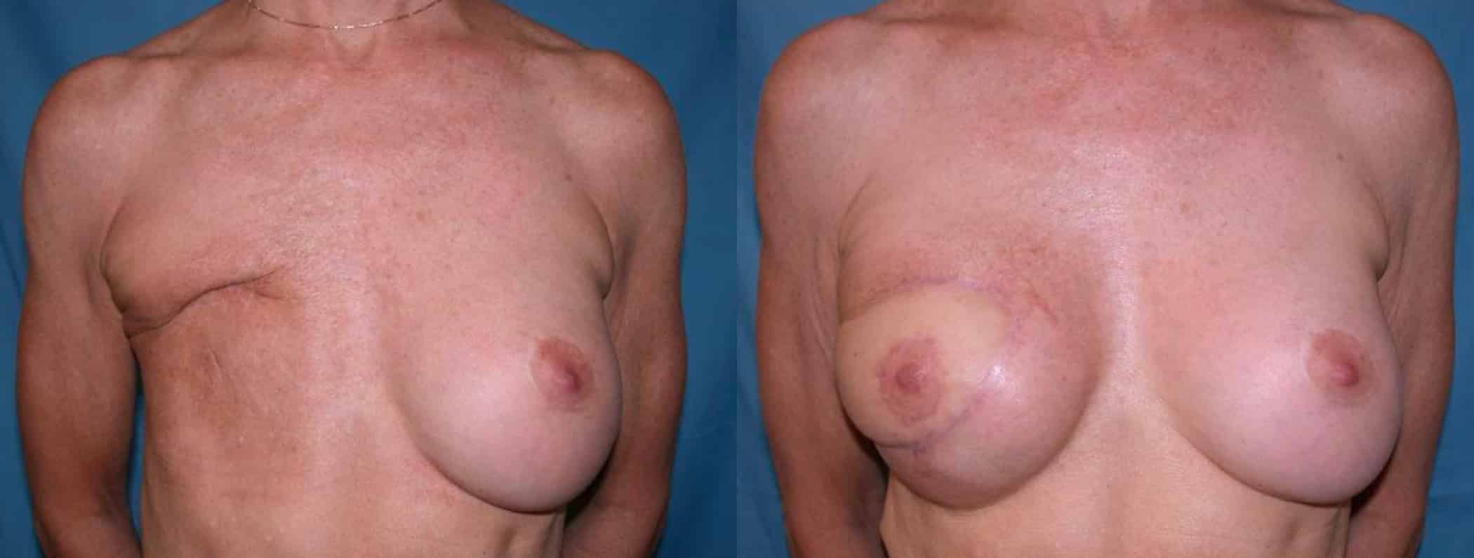 Before and After Image: Breast Reconstruction - front