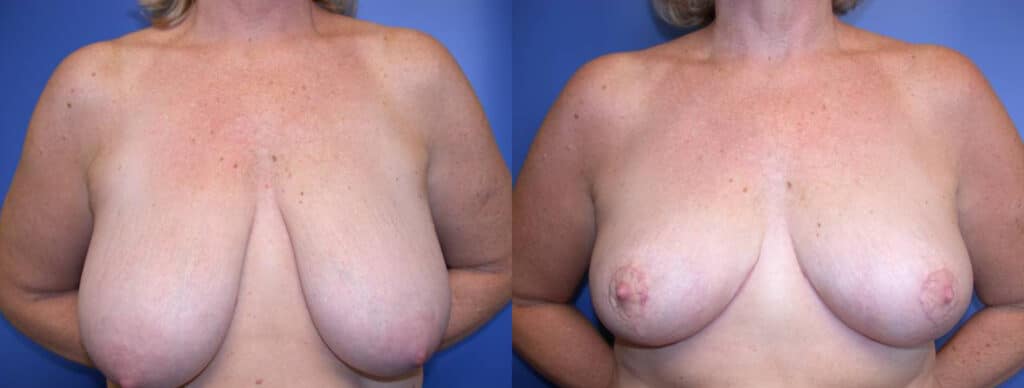 Before and After Image: Breast Reduction - front