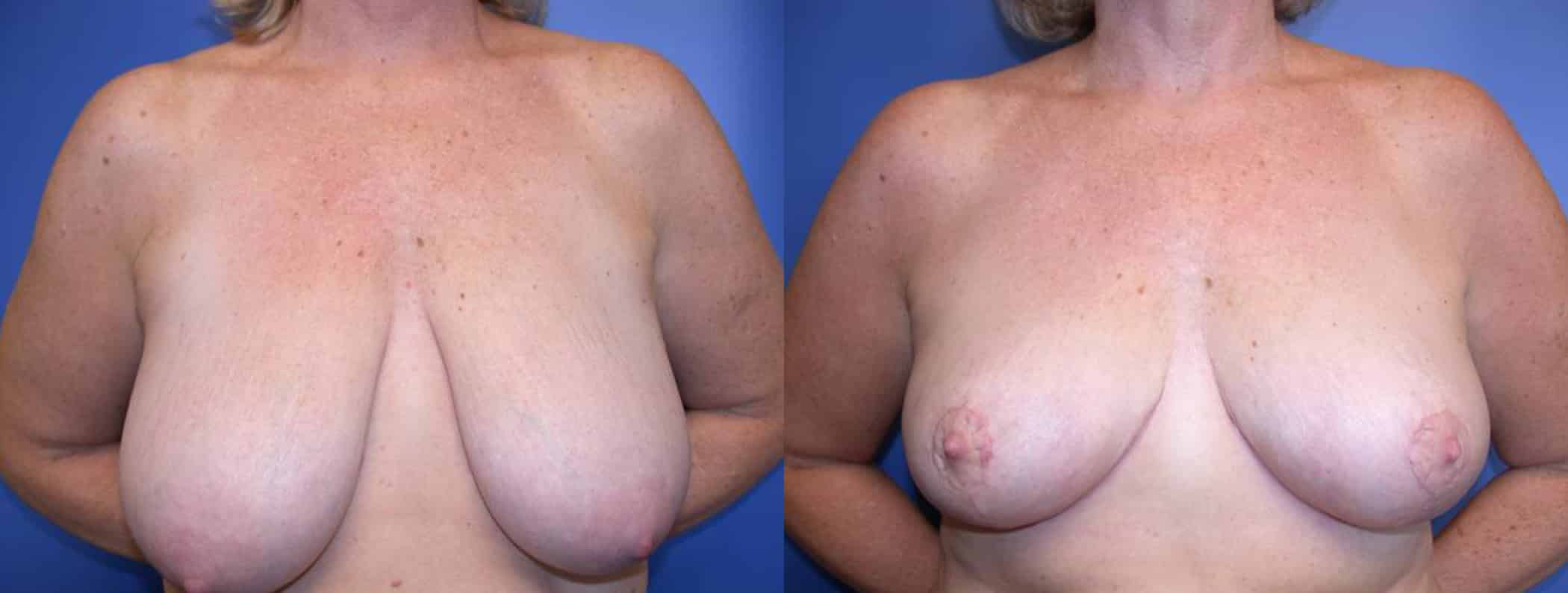 Before and After Image: Breast Reduction - front