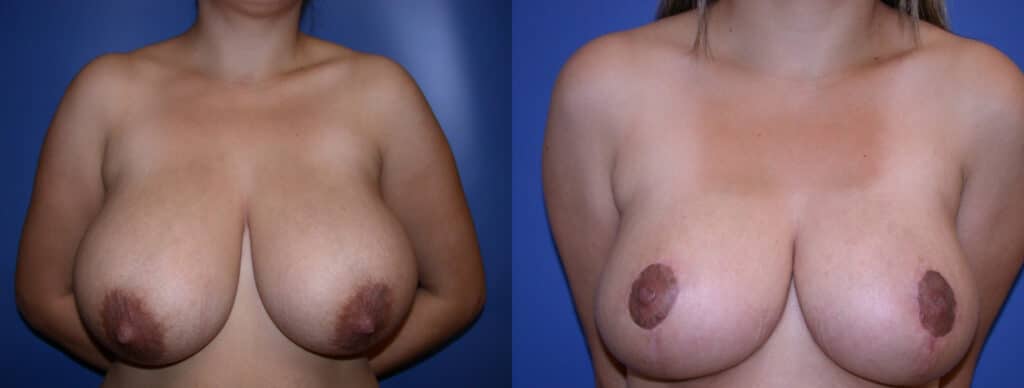 Before and After Image: Breast Reduction - front
