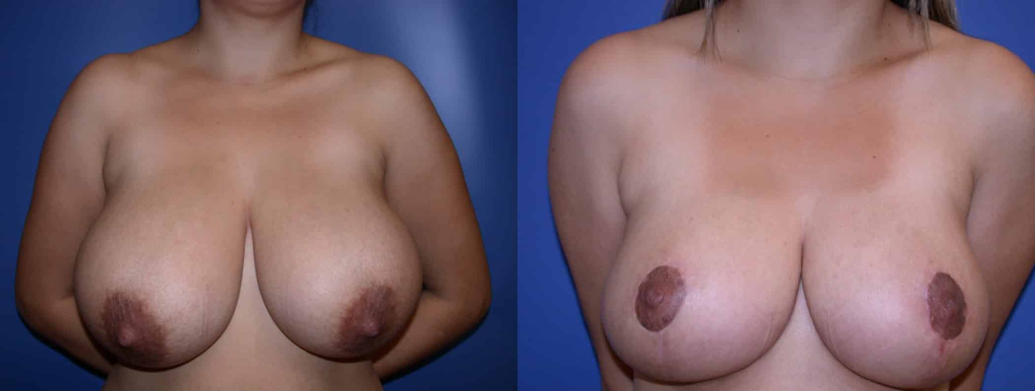 Before and After Image: Breast Reduction - front