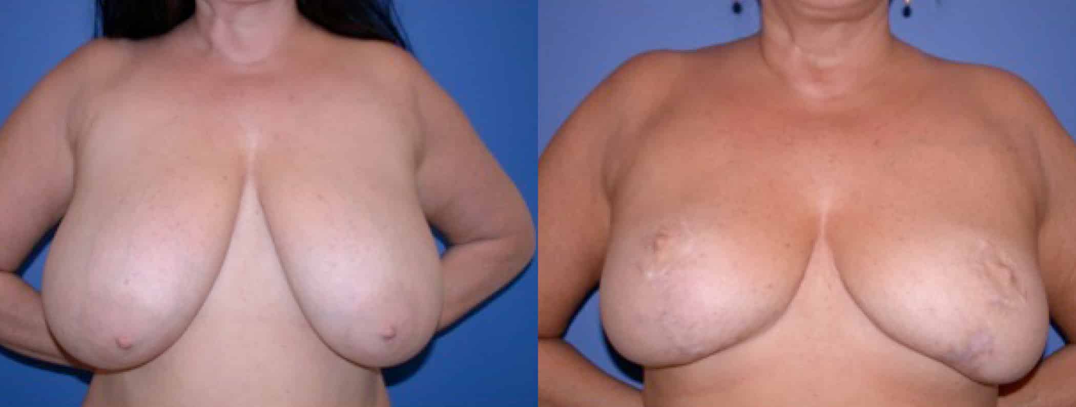 Before and After Image: Breast Reduction - front