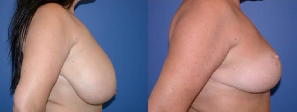 Before and After Image: Breast Reduction - right-side