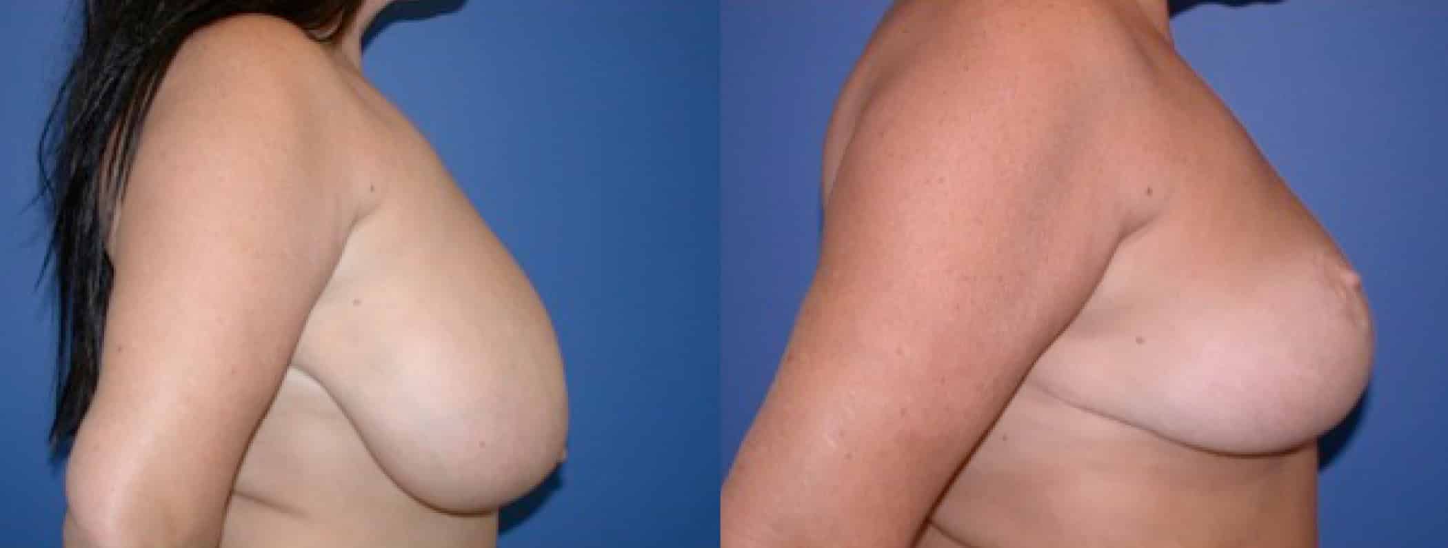 Before and After Image: Breast Reduction - right-side