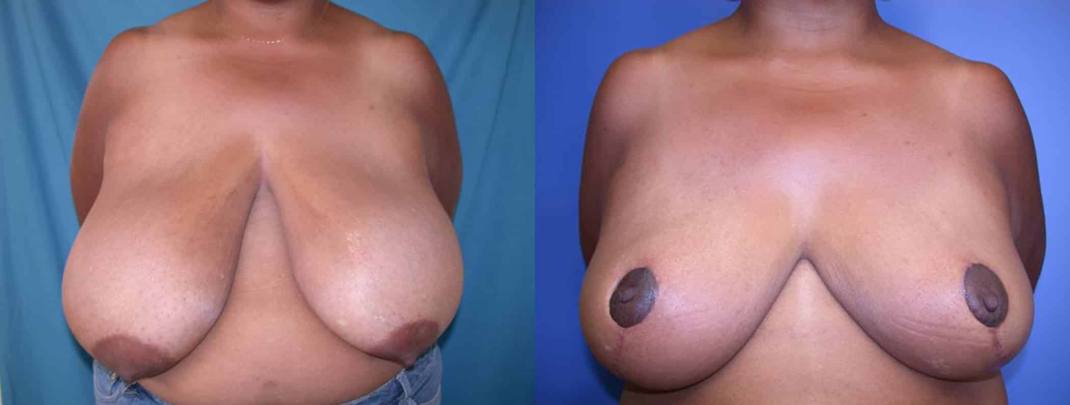 Before and After Image: Breast Reduction - front