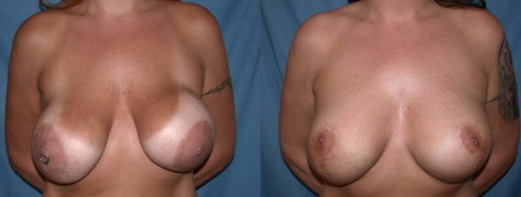 Before and After Image: Breast Revision - front