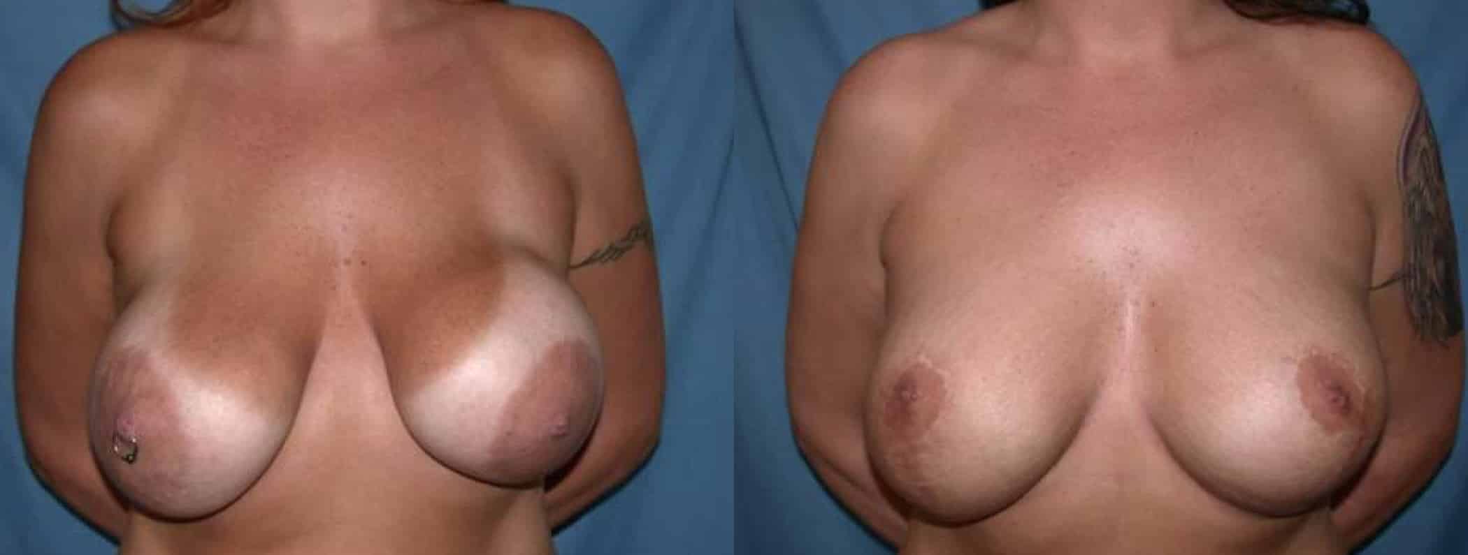 Before and After Image: Breast Revision - front