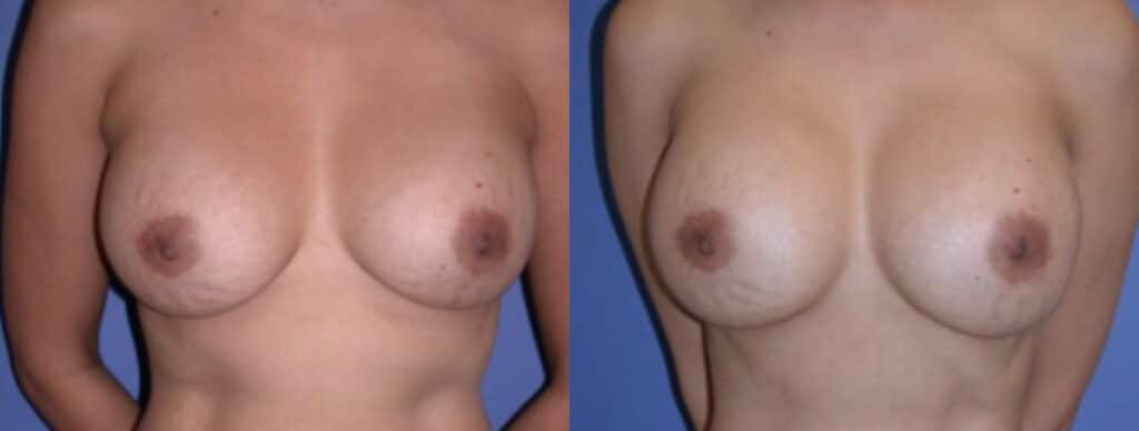 Before and After Image: Breast Revision - front