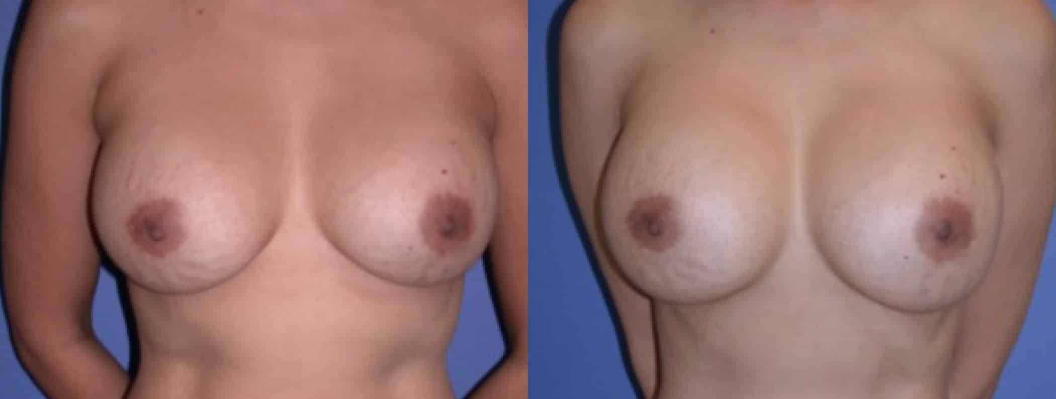 Before and After Image: Breast Revision - front