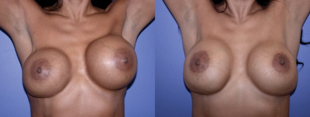 Before and After Image: Breast Revision - front