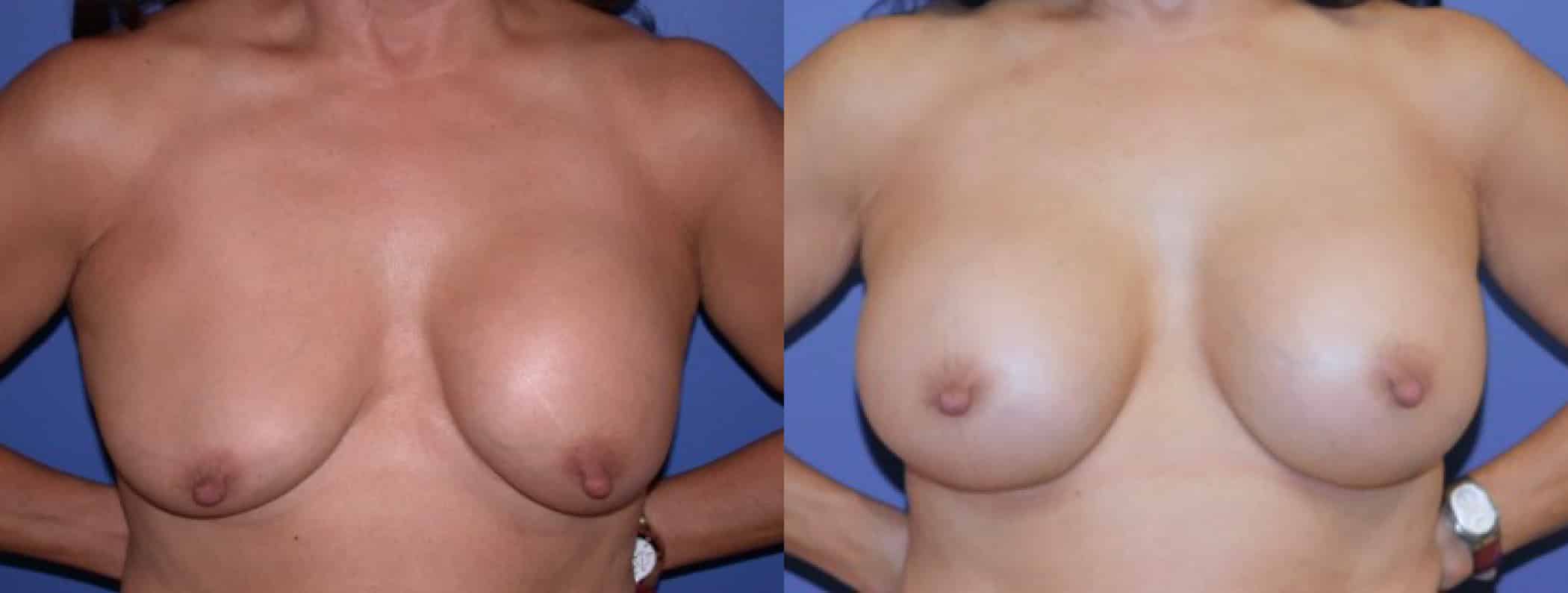 Before and After Image: Breast Revision - front