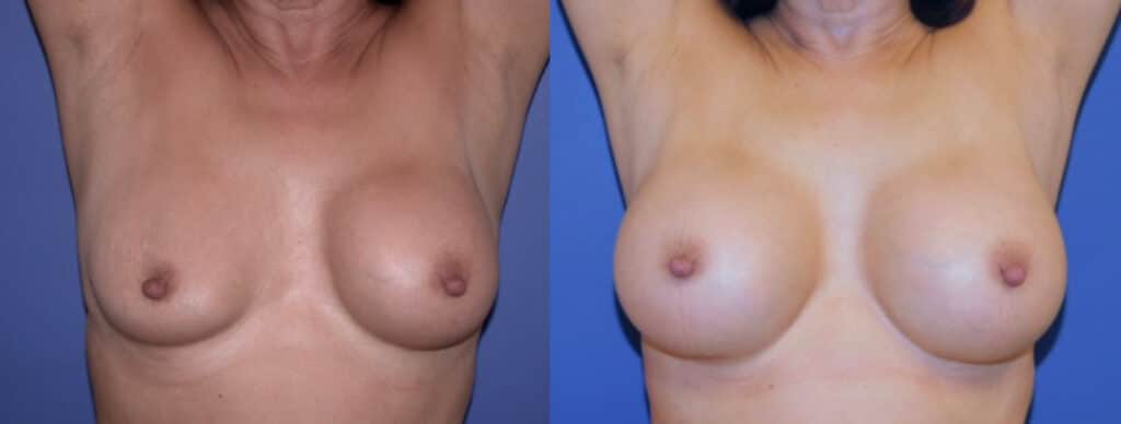 Before and After Image: Breast Revision - front