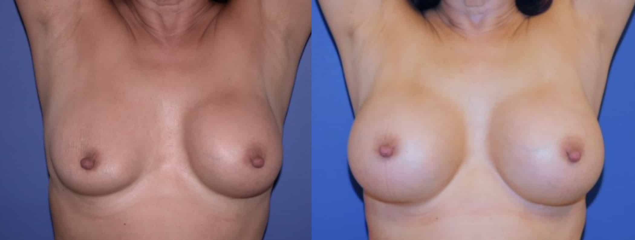 Before and After Image: Breast Revision - front