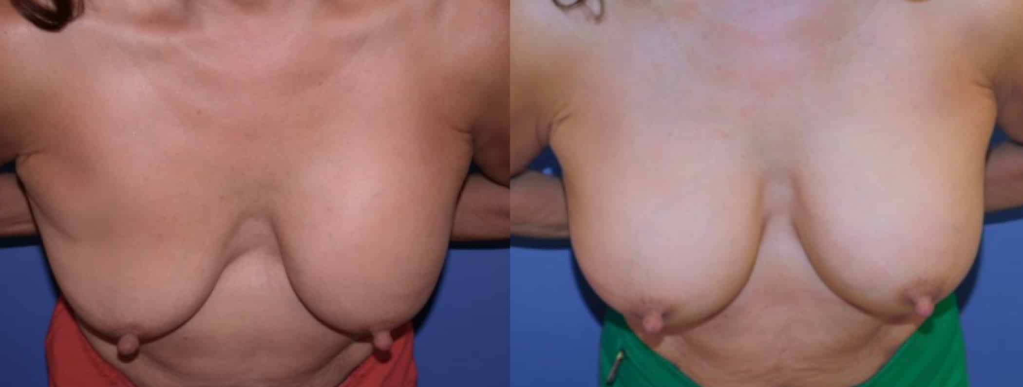 Before and After Image: Breast Revision - front