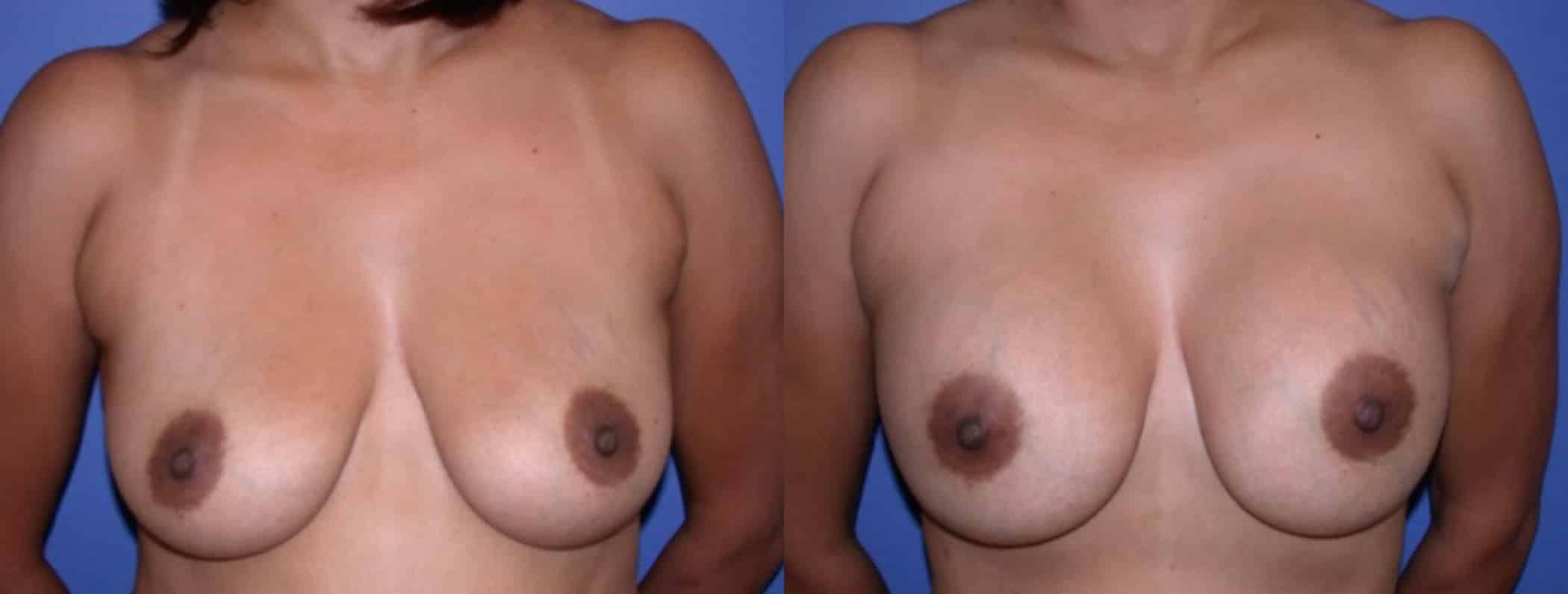 Before and After Image: Breast Revision - front