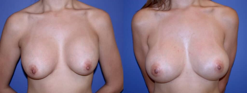 Before and After Image: Breast Revision - front