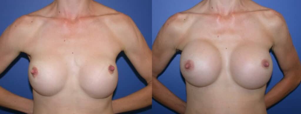 Before and After Image: Breast Revision - front