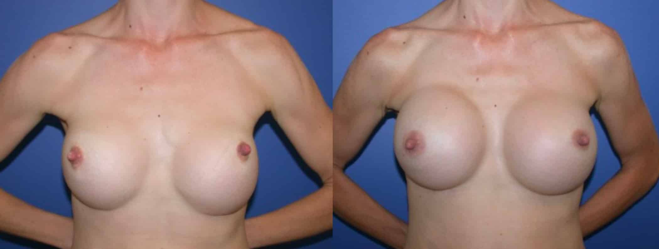 Before and After Image: Breast Revision - front