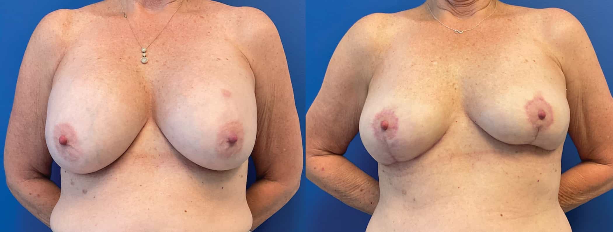 Before and After Image: Explantation / Dr. Q’s Novel Breast Flaps Reconstruction (No New Implants) - front